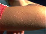 Thumbnail image for Common keratosis pilaris outbreaks