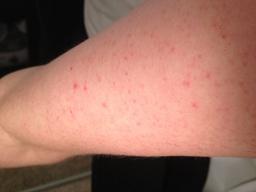 Thumbnail image for What does keratosis pilaris look like?
