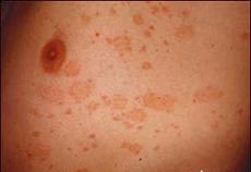 Thumbnail image for Keratosis Pilaris On The Chest