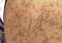 Thumbnail image for Why is my keratosis pilaris getting worse?