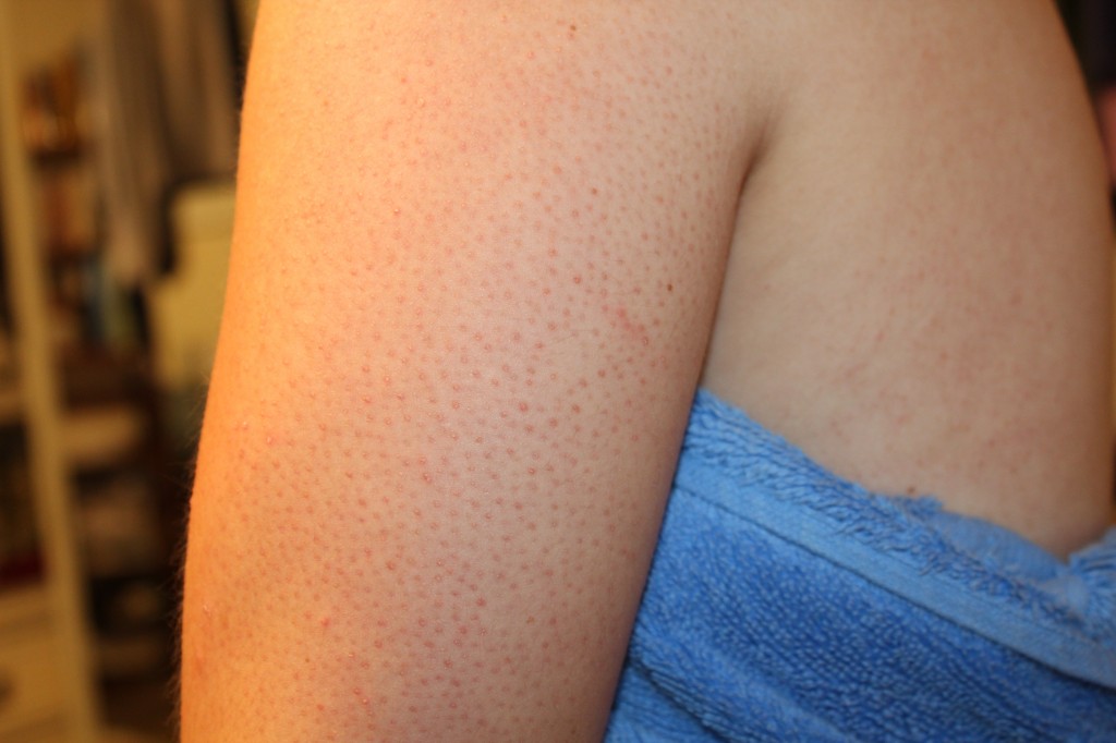 common-keratosis-pilaris-on-arms-keratosis-pilaris-treatment-options