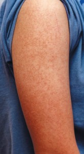 Thumbnail image for Common keratosis pilaris on arms