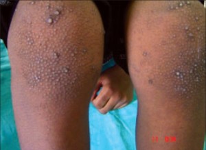 severe keratosis pilkaris on the legs