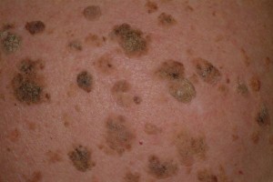 Types of Seborrheic Keratosis | Dermatology Education